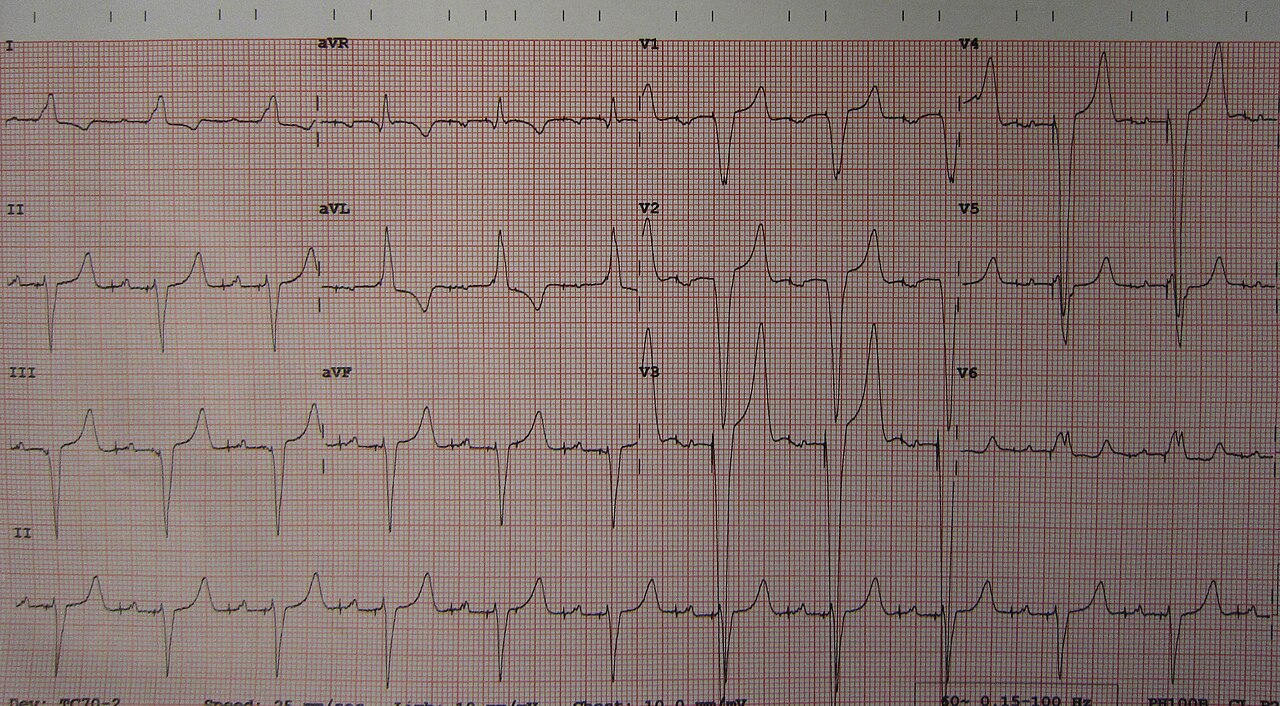 An ECG of a person with a dual-chamber pacemaker